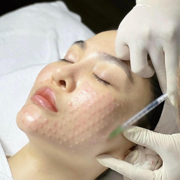 mpihdqjpou0blf1nzdiid_l6k71mpdhcmydphazn7wj2xxl1c4ltumrepo5flxg9asqsy_qrdw9rs542cku5lw_e4lx_effmulhiuyf5w622 Tiêm meso là gì? Tác dụng của tiêm meso trong làm đẹp da.