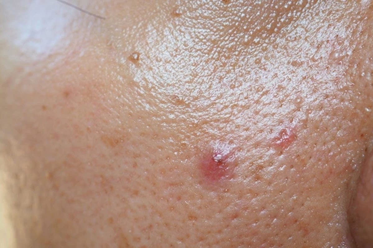 nguyen_nhan_gay_da_bong_nhon Da nhờn là như thế nào? Nguyên nhân gây ra da nhờn là gì?