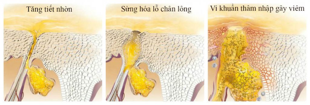 sua-rua-mat-cho-da-dau-mun-tuoi-day-thi