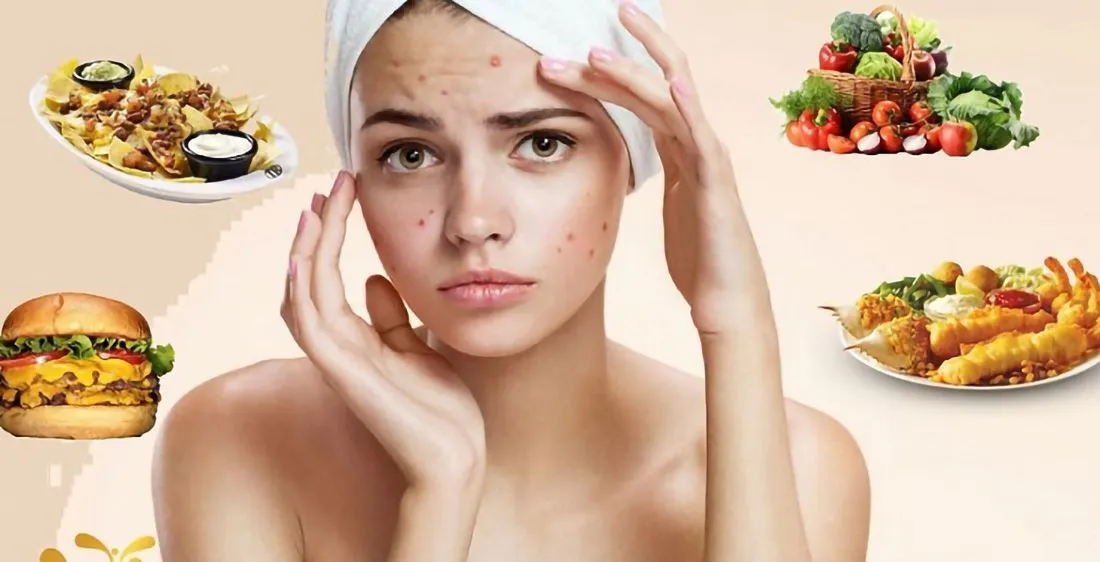 Chế độ ăn uống đóng vai trò quan trọng trong việc kiểm soát mụn trứng cá từ bên trong