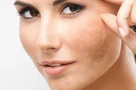Làn da mới tái tạo sau khi tắm trắng rất dễ bị tổn thương bởi tia UV nếu không được bảo vệ kỹ lưỡng