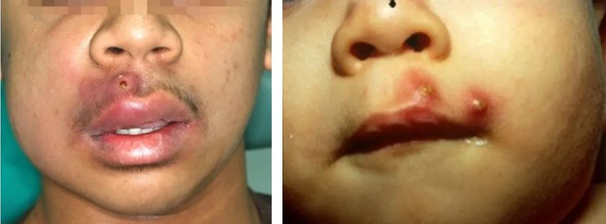 Mụn đinh râu sưng tấy không cồi là tình trạng viêm nhiễm nghiêm trọng cần được xử lý cẩn trọng