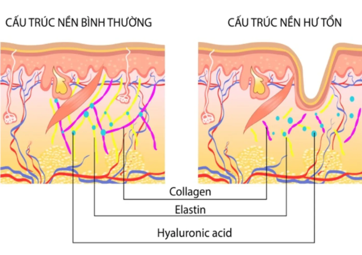 4657-cau-truc-nen-cua-da-bi-hu-ton Sự đứt gãy các sợi nâng đỡ collagen và elastin là nguyên nhân chính hình thành nếp nhăn tĩnh