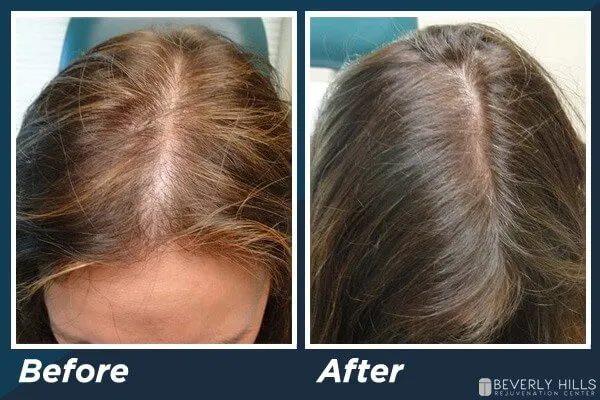 606f8d404030eef4651a7031_low-level-laser-therapy-hair-loss-ba-2 Sự thay đổi rõ rệt về mật độ tóc sau khi thực hiện liệu trình Laser LLLT