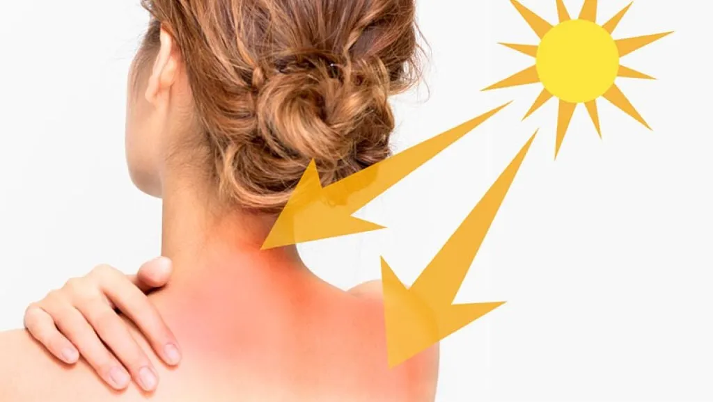 Làn da bị đỏ rát và tổn thương sau khi tiếp xúc quá lâu với ánh nắng mặt trời gay gắt