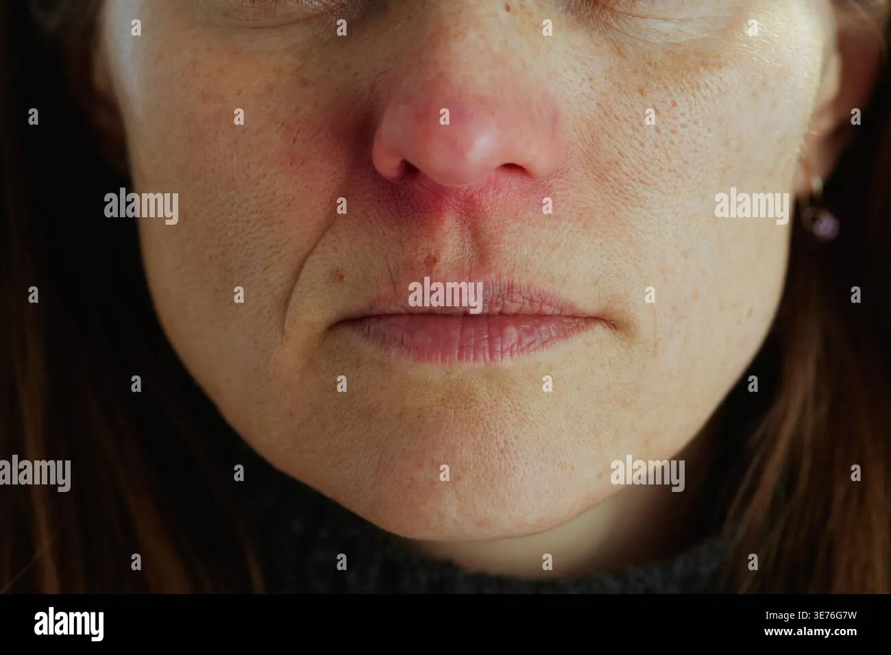 a-close-up-portrait-of-a-woman-showing-visible-skin-irritation-and-redness-around-the-nose-and-mouth-highlighting-sensitive-skin-concerns-and-dermato-3e76g7w Da nhạy cảm thường có biểu hiện mẩn đỏ do hàng rào bảo vệ bị suy yếu và mất cân bằng vi sinh