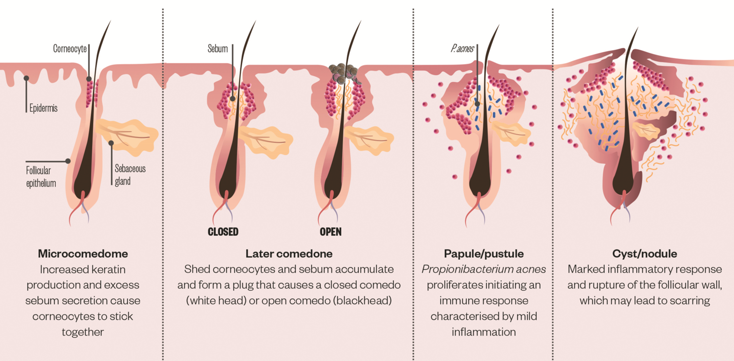 acne-pathogenesis-17 Quá trình hình thành mụn viêm do sự gia tăng dầu thừa dưới tác động của Cortisol