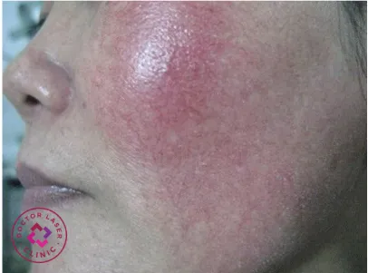 Dấu hiệu giãn mao mạch và mụn viêm bùng phát trên nền da nhiễm corticoid