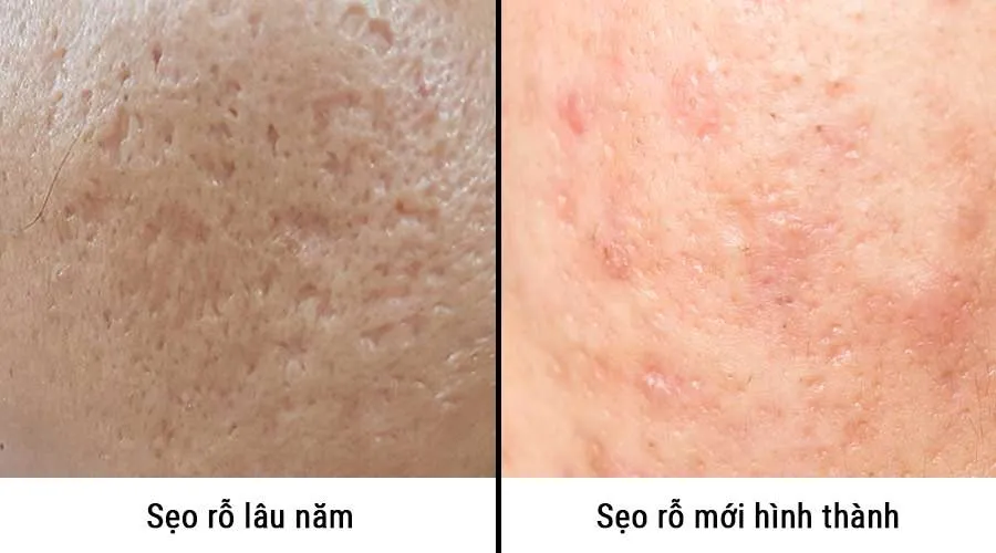 Sự khác biệt về cấu trúc collagen giữa da thường và da bị sẹo rỗ xơ hóa