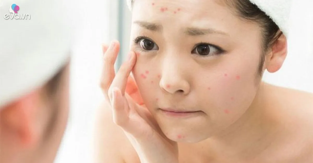 Áp lực cuộc sống hiện đại là tác nhân hàng đầu gây mụn nội tiết ở người trưởng thành