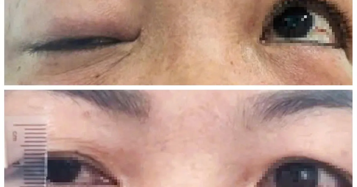 Chăm sóc vùng da mắt đúng cách giúp ngăn ngừa tình trạng sụp mí do lão hóa