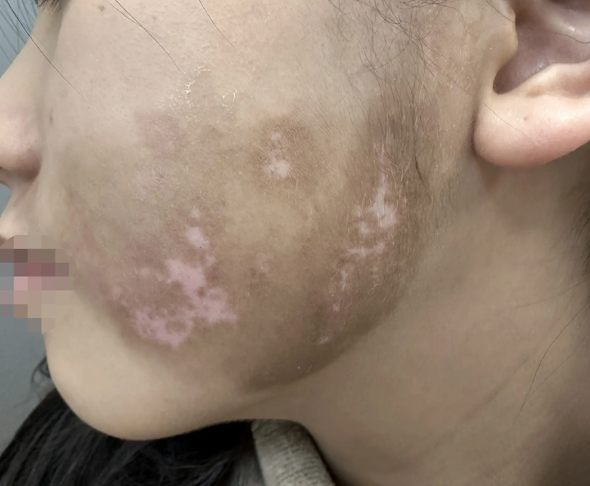 Tình trạng rối loạn melanin gây ra các mảng trắng đặc trưng của bệnh bạch biến