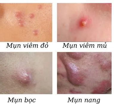 Tác dụng làm dịu nốt mụn sưng đỏ rõ rệt sau khi áp dụng nhiệt độ lạnh