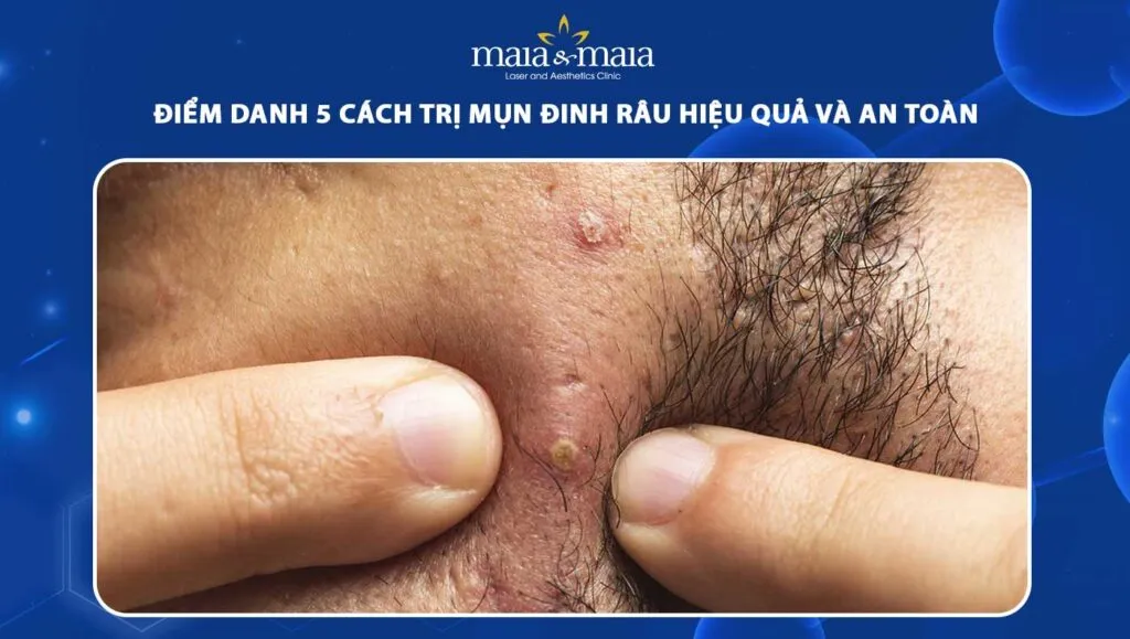 Chườm ấm là phương pháp hiệu quả giúp giảm đau và thúc đẩy quá trình gom cồi mụn tự nhiên