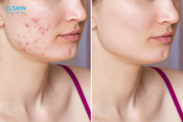 Sát trùng da đúng cách là bước quan trọng nhất để ngăn ngừa biến chứng sau khi nặn mụn