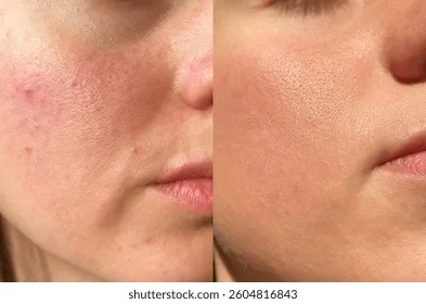 Làn da khỏe mạnh sạch mụn là kết quả của việc kiên trì sử dụng ánh sáng xanh đúng tần suất