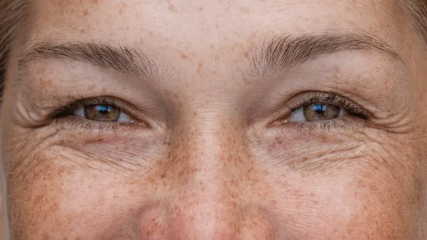 closeup-womans-eyes-smiling-into-600nw-2674823815 Vết chân chim đuôi mắt là dấu hiệu lão hóa tự nhiên khiến gương mặt trông mệt mỏi hơn