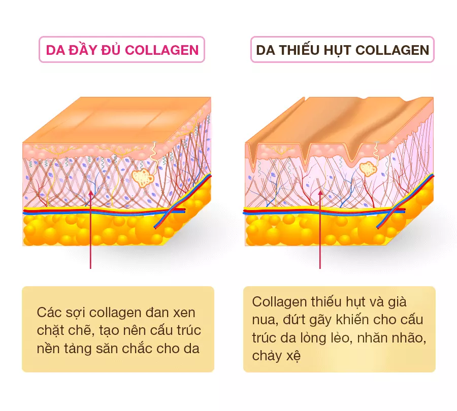Sự suy giảm collagen và elastin là nguyên nhân chính dẫn đến sụp mí mắt