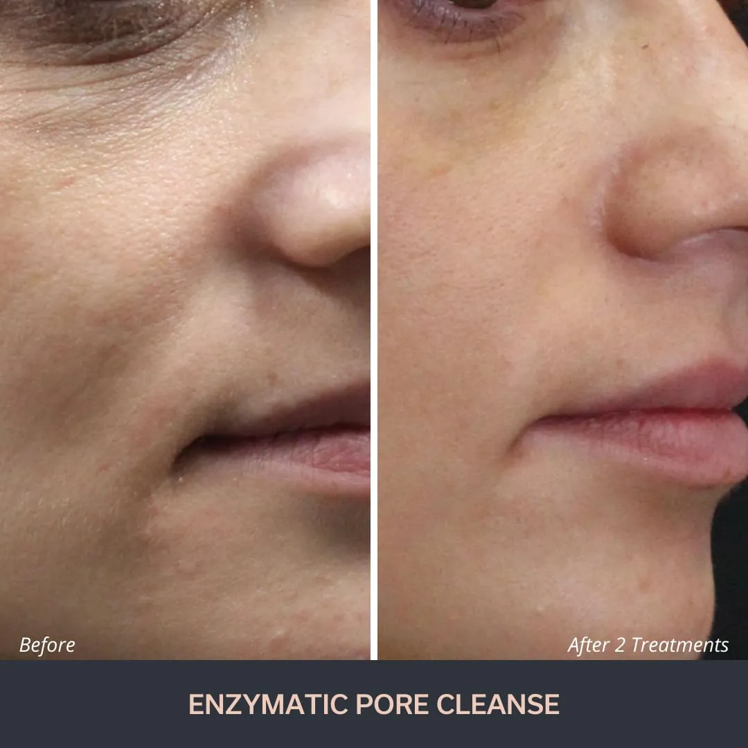 enzyme-peel-treatment-before-after Sự thay đổi rõ rệt về độ săn chắc và sắc thái da sau liệu trình Galvanic