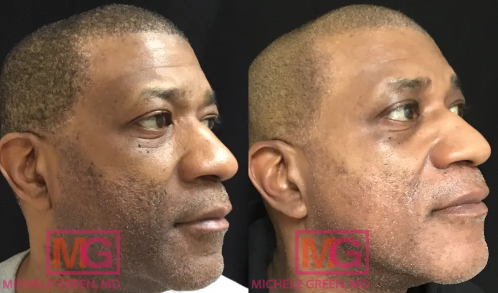 gr-52-years-facial-pigmentation-treatment-mgwatermark Chuyên gia da liễu đang thăm khám tình trạng tăng sắc tố da sau khi sử dụng hoạt chất mạnh