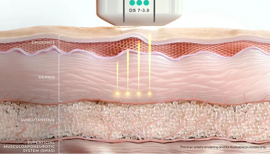 Sự hình thành mạng lưới collagen mới giúp thắt chặt cấu trúc xung quanh lỗ chân lông
