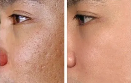 Sự cải thiện rõ rệt của làn da sau khi kết hợp can thiệp y khoa và dược mỹ phẩm