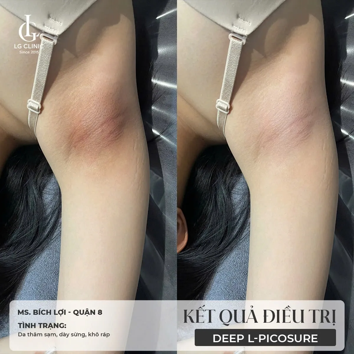 hinh-anh-tri-tham-nach-1 Sự ma sát từ trang phục chật chội là nguyên nhân tiềm ẩn gây thâm sạm da