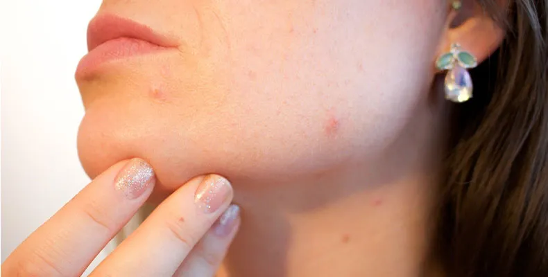 Mụn nội tiết thường xuất hiện ở vùng quai hàm và cằm do biến động hormone