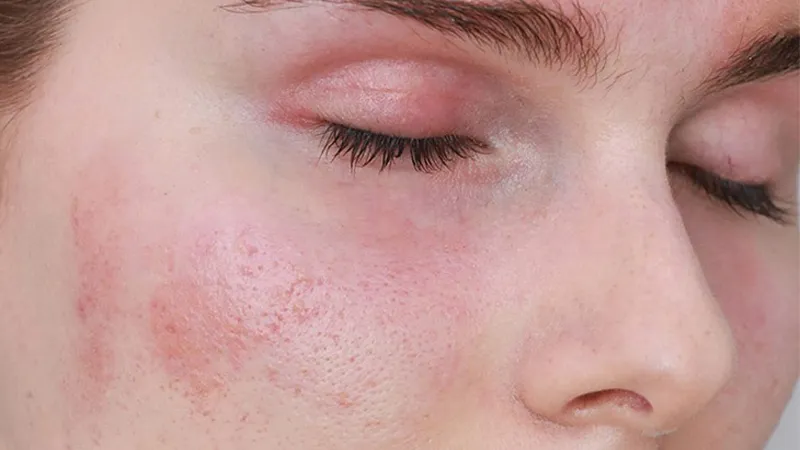 Khả năng làm dịu tức thì các vết mẩn đỏ và kích ứng do ô nhiễm môi trường