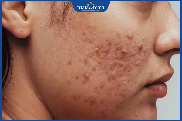 ma-moc-mun-trung-ca Vỏ gối không được vệ sinh thường xuyên là nguyên nhân hàng đầu gây mụn hai bên má