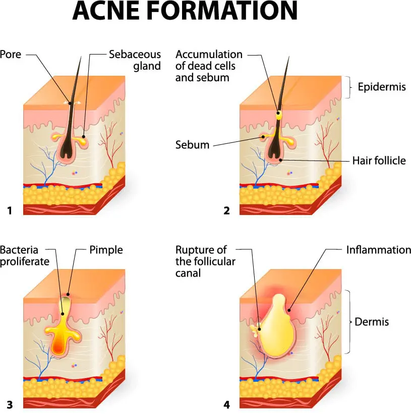 mooresville-acne-dermatology-1 Cơ chế hình thành mụn do sự kết hợp của dầu thừa tế bào chết và vi khuẩn