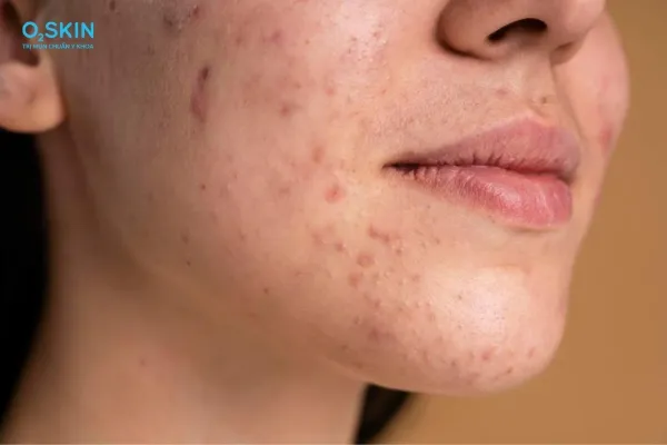 Sử dụng hoạt chất đặc trị giúp kiểm soát ổ viêm nhanh chóng