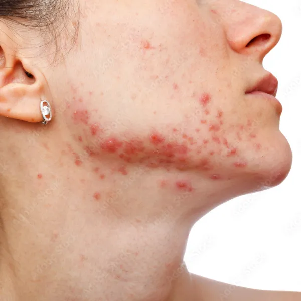 Mụn nang dưới cằm trước kỳ kinh thường gây đau nhức và ảnh hưởng lớn đến thẩm mỹ