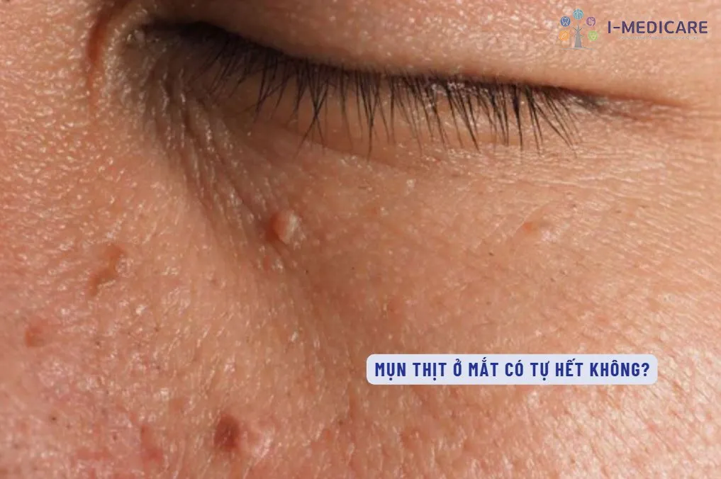 Tình trạng mụn thịt xuất hiện dày đặc quanh vùng mắt do sử dụng mỹ phẩm không phù hợp