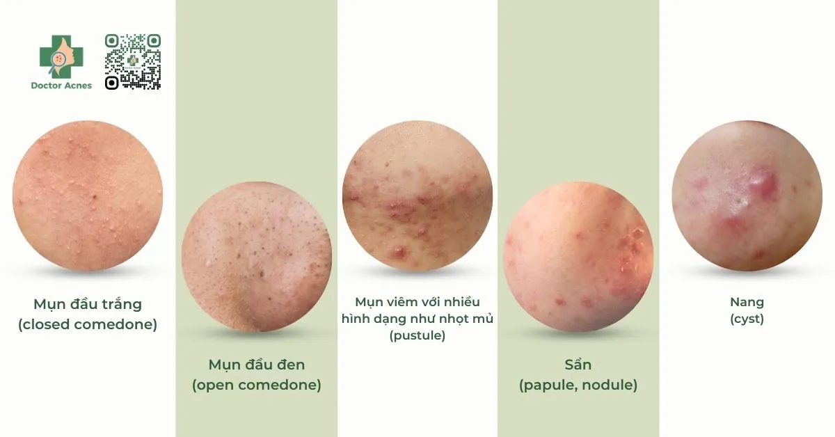 Mụn nang cần thời gian dài để phục hồi so với các loại mụn thông thường