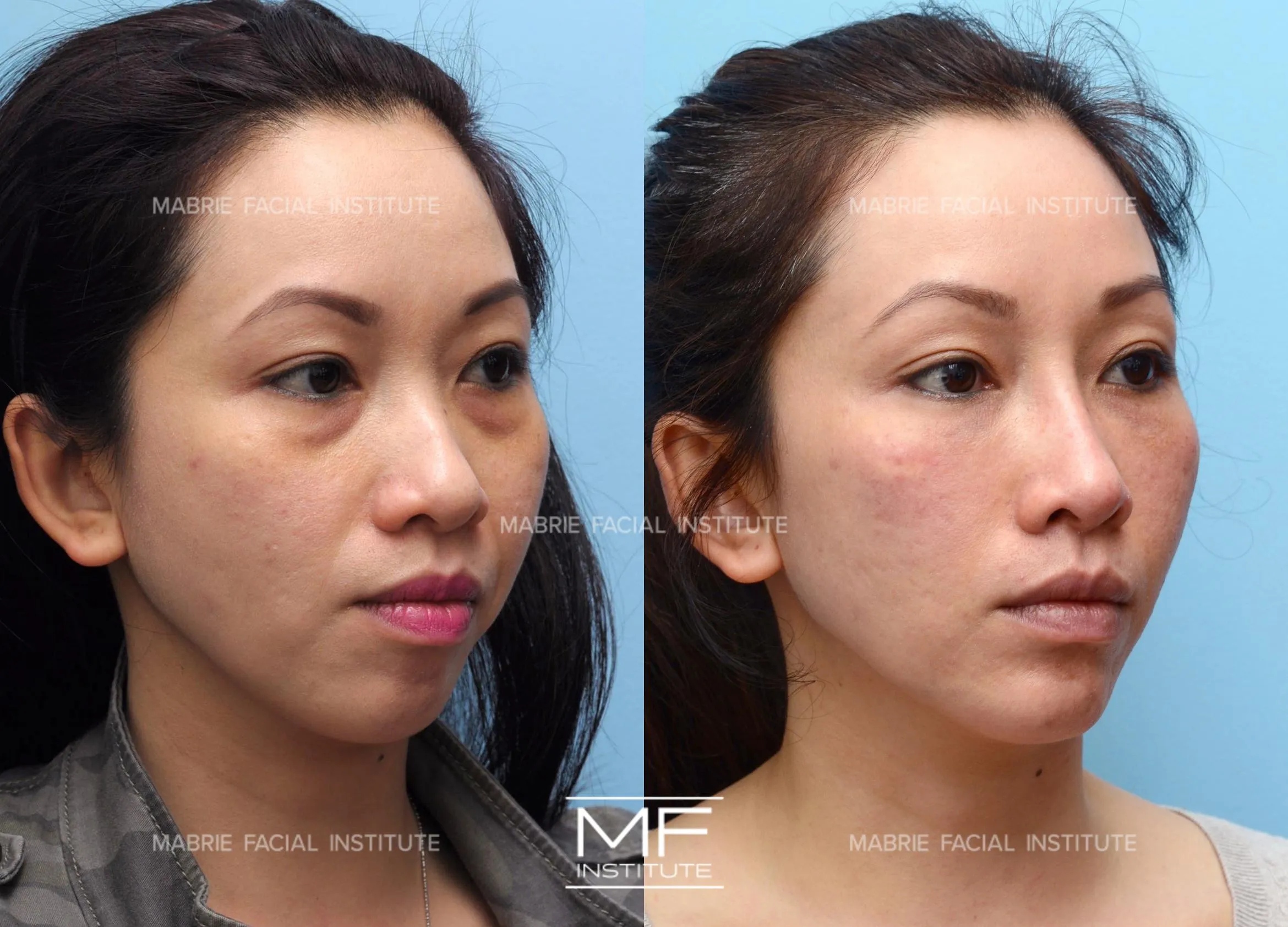 nasolabial-folds-967-view-2-detail Sự thay đổi của rãnh cười trước và sau khi áp dụng quy trình bôi thoa phục hồi chuyên sâu