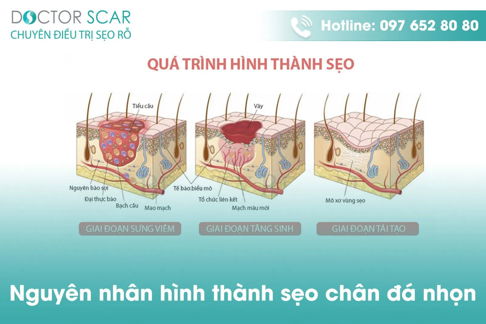Sẹo rỗ đáy nhọn là loại sẹo có cấu trúc phức tạp và khó điều trị nhất trong các loại sẹo rỗ