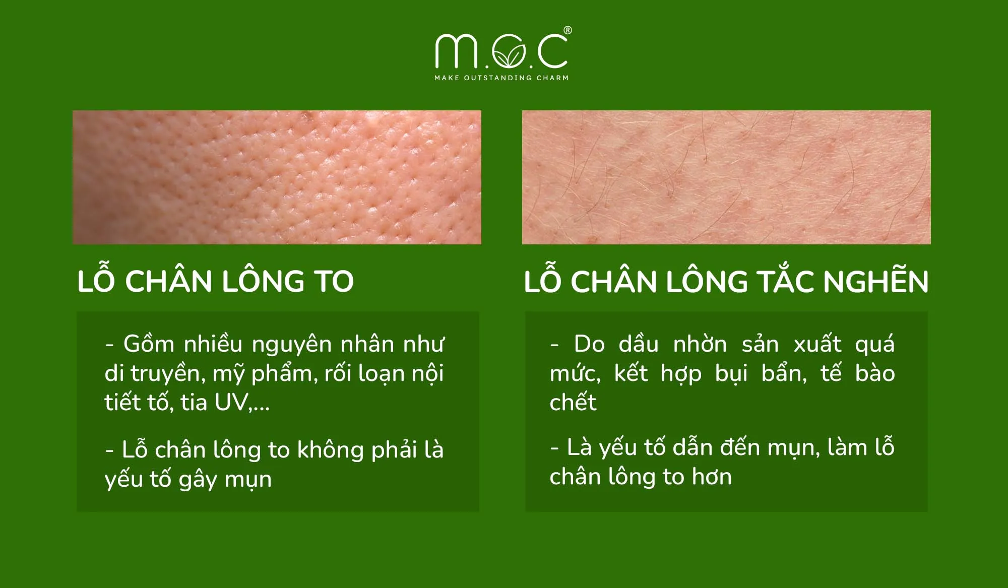 phan-biet-lo-chan-long-to-va-tac-nghen Sự khác biệt rõ rệt về cấu trúc lỗ chân lông giúp phân biệt hai tình trạng da