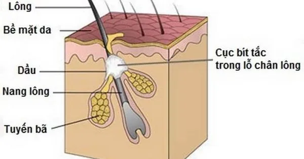 Mô phỏng quá trình Keratin bị kẹt lại dưới da tạo thành mụn thịt