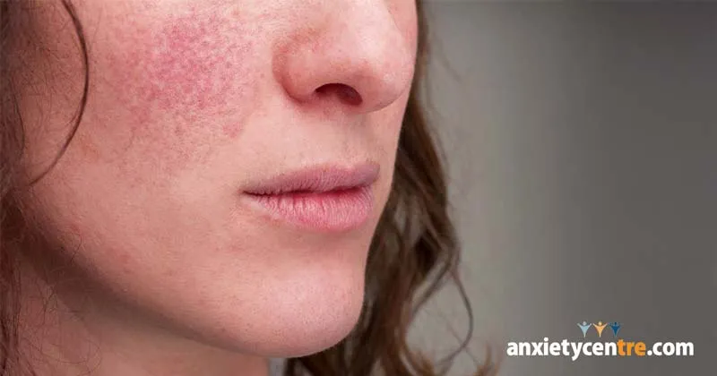 red-skin-and-anxiety Làn da nhạy cảm và căng thẳng cần sự can thiệp của các hoạt chất làm dịu thần kinh chuyên sâu