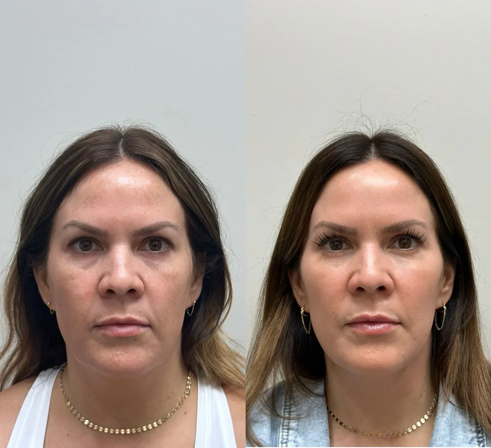 Sự khác biệt rõ rệt của làn da trước và sau khi được bổ sung Hyaluronic Acid đầy đủ
