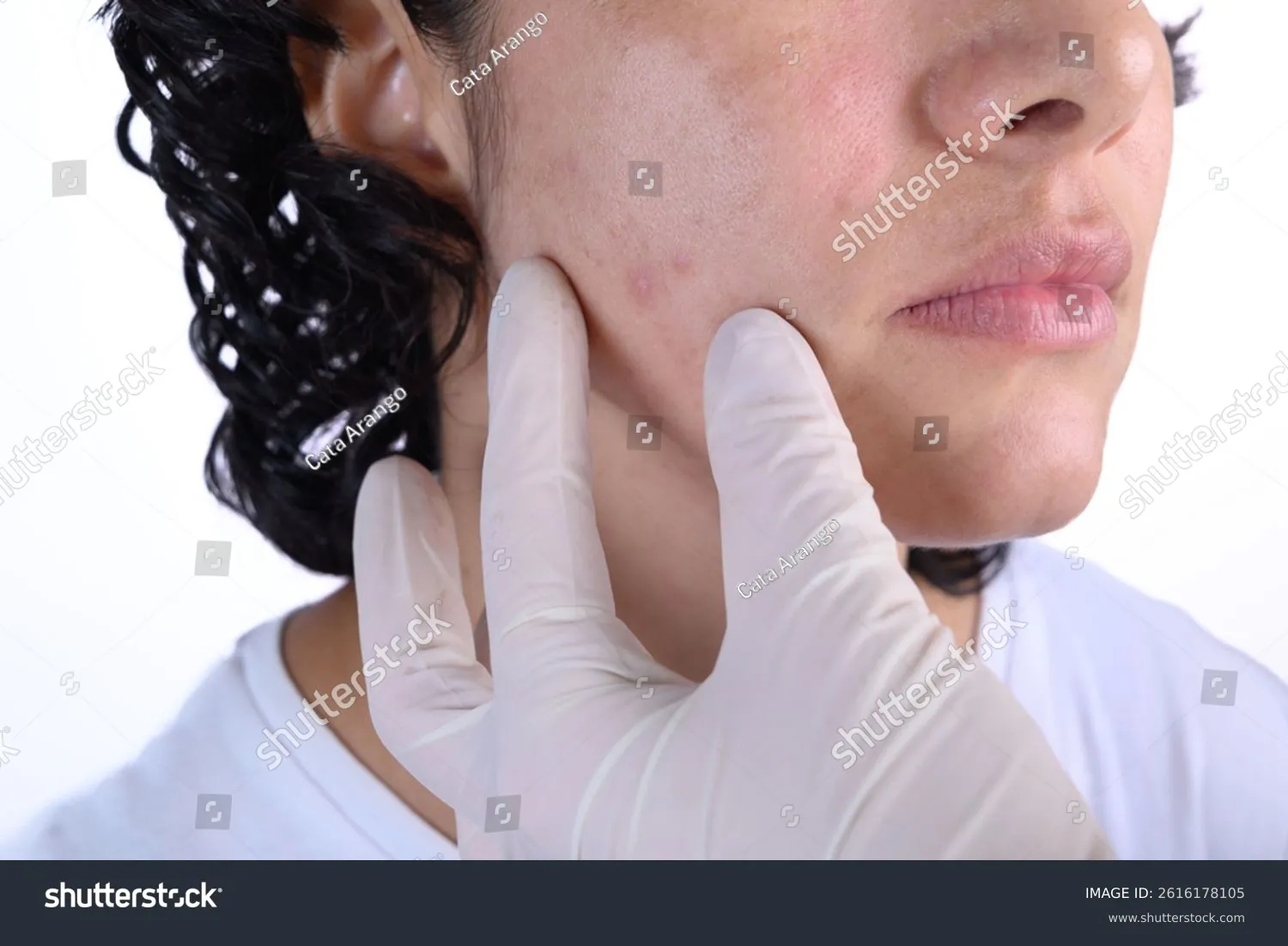 Sự can thiệp tối giản giúp các hoạt chất điều trị mụn phát huy tối đa công năng trên da