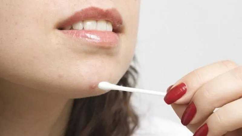 Chấm mụn đúng cách bằng tăm bông giúp hạn chế làm khô vùng da xung quanh