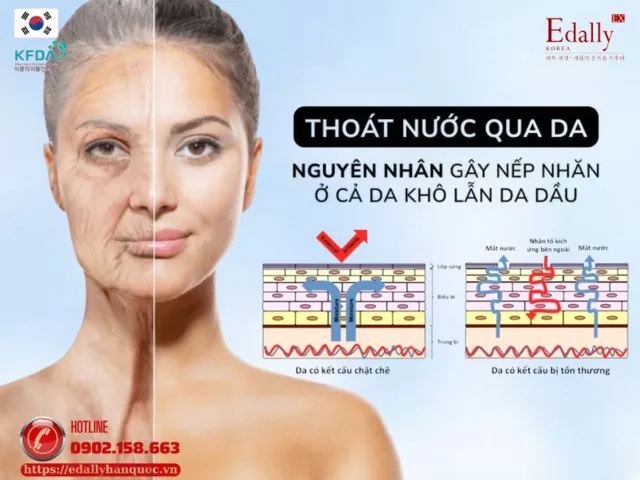 thoat-nuoc-qua-da-nguyen-nhan-gay-nep-nhan-o-ca-da-kho-lan-da-dau Sự khác biệt giữa làn da đủ nước và làn da bị mất nước do ngồi máy lạnh lâu ngày