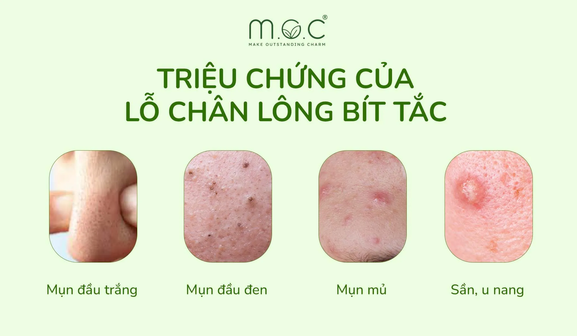 Lỗ chân lông thông thoáng giúp da mịn màng và hấp thụ dưỡng chất tốt hơn