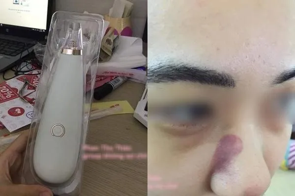 Sử dụng máy hút mụn cám là phương pháp phổ biến nhưng cần thực hiện đúng cách để bảo vệ da
