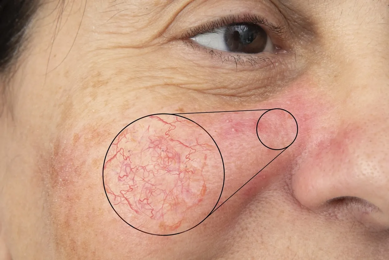 womans-face-with-broken-capillaries Làn da bị tổn thương nghiêm trọng mỏng yếu và lộ mao mạch do sử dụng các sản phẩm lột tẩy sai cách